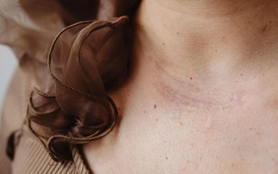 Types of Scars